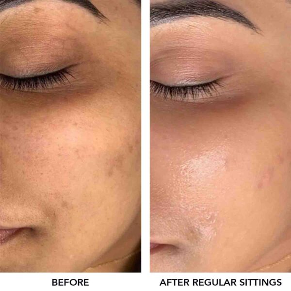 O3+Meladerm Vitamin C Gel Bleach for Lightens Skin & Hair