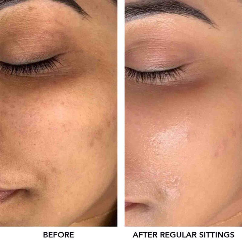 O3+Meladerm Vitamin C Gel Bleach for Lightens Skin & Hair